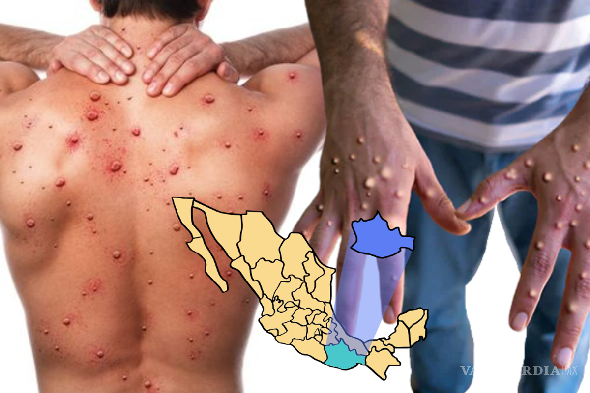 Confirman caso de viruela símica en hombre de 26 años en Oaxaca; intensifican vigilancia epidemiológica