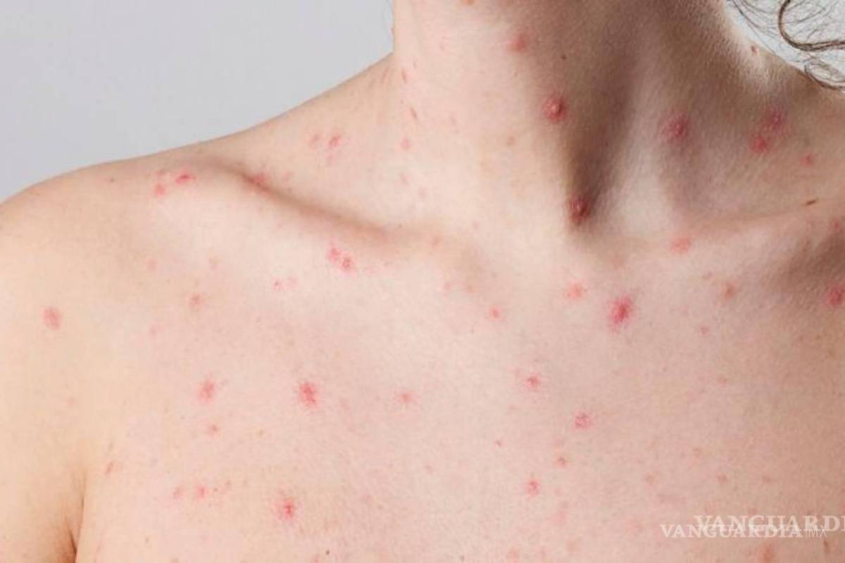 Confirman desde Colima el primer contagio de viruela del mono en la entidad