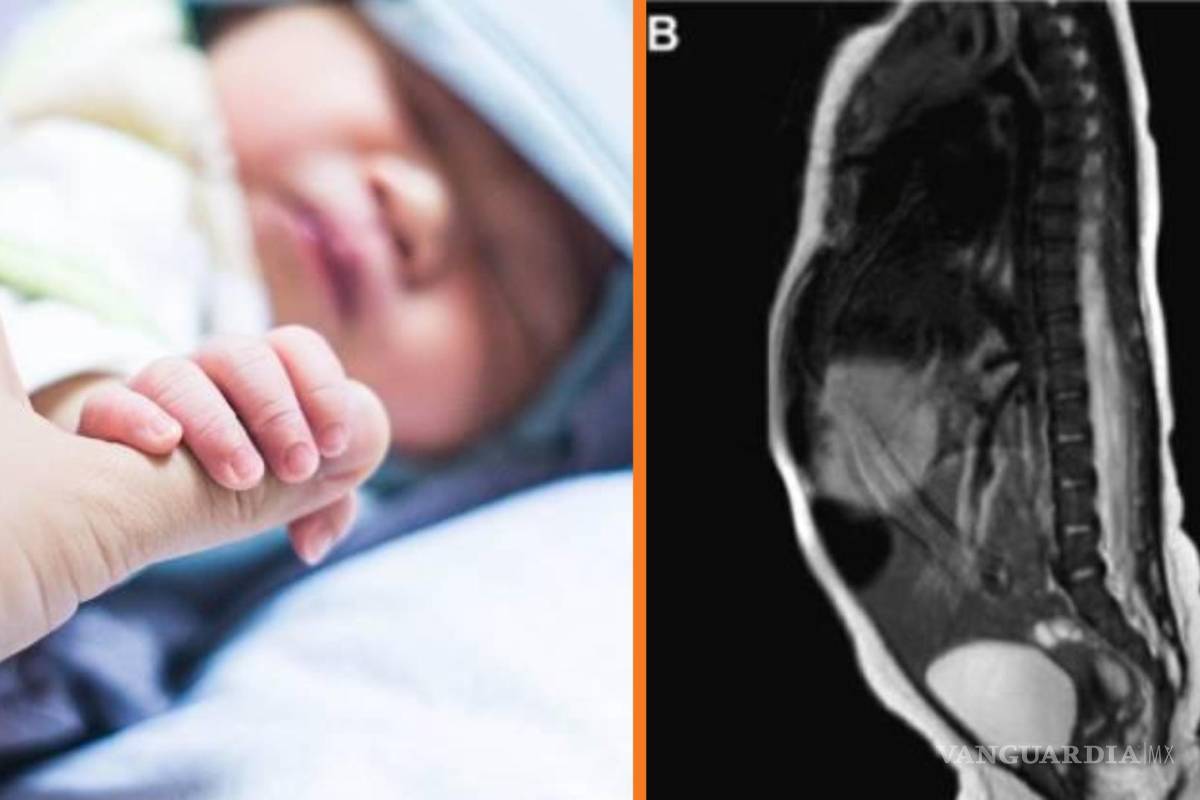 Nace en Nuevo León bebé con cola de 5.7 centímetros de largo, documenta revista médica