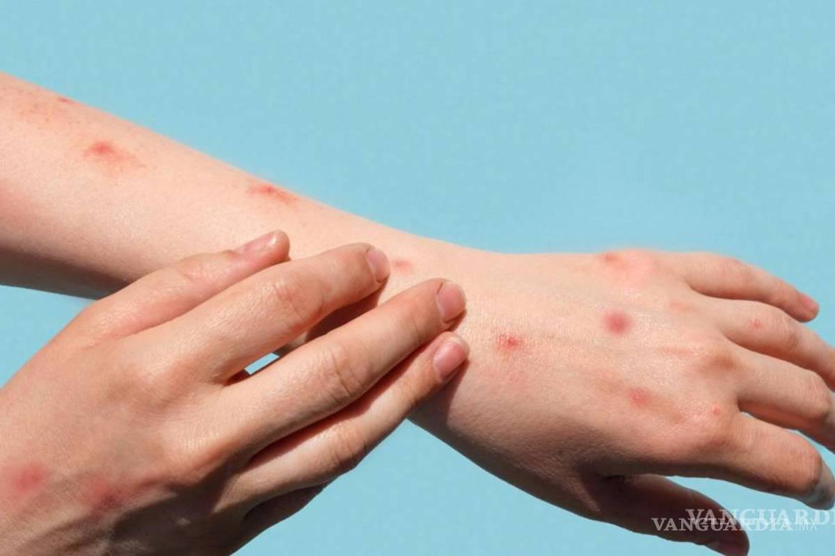 Tamaulipas en alerta por turista de Playa Miramar positivo a viruela del mono