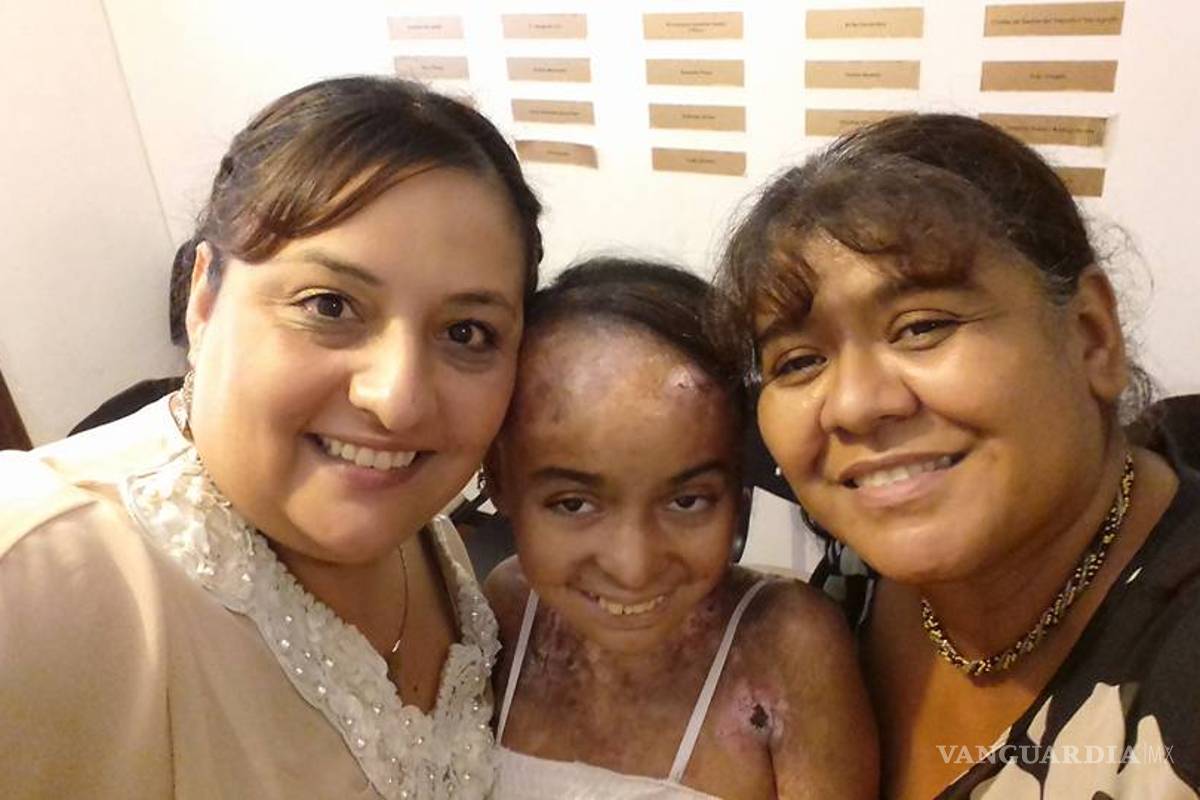 Piden apoyo para Alma, joven de Monclova que padece 'piel de mariposa'