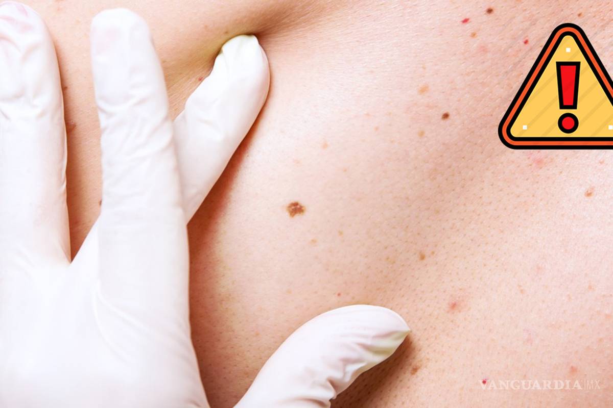 ¡Cuidado con el cáncer de piel! ¿Te estás protegiendo?