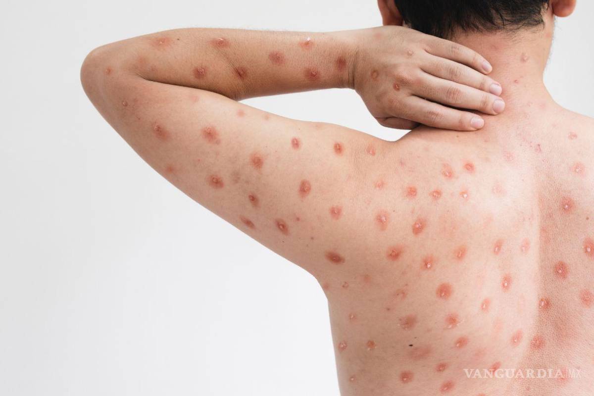 Reportan cero casos de viruela del mono en Coahuila... pero mantienen vigilancia