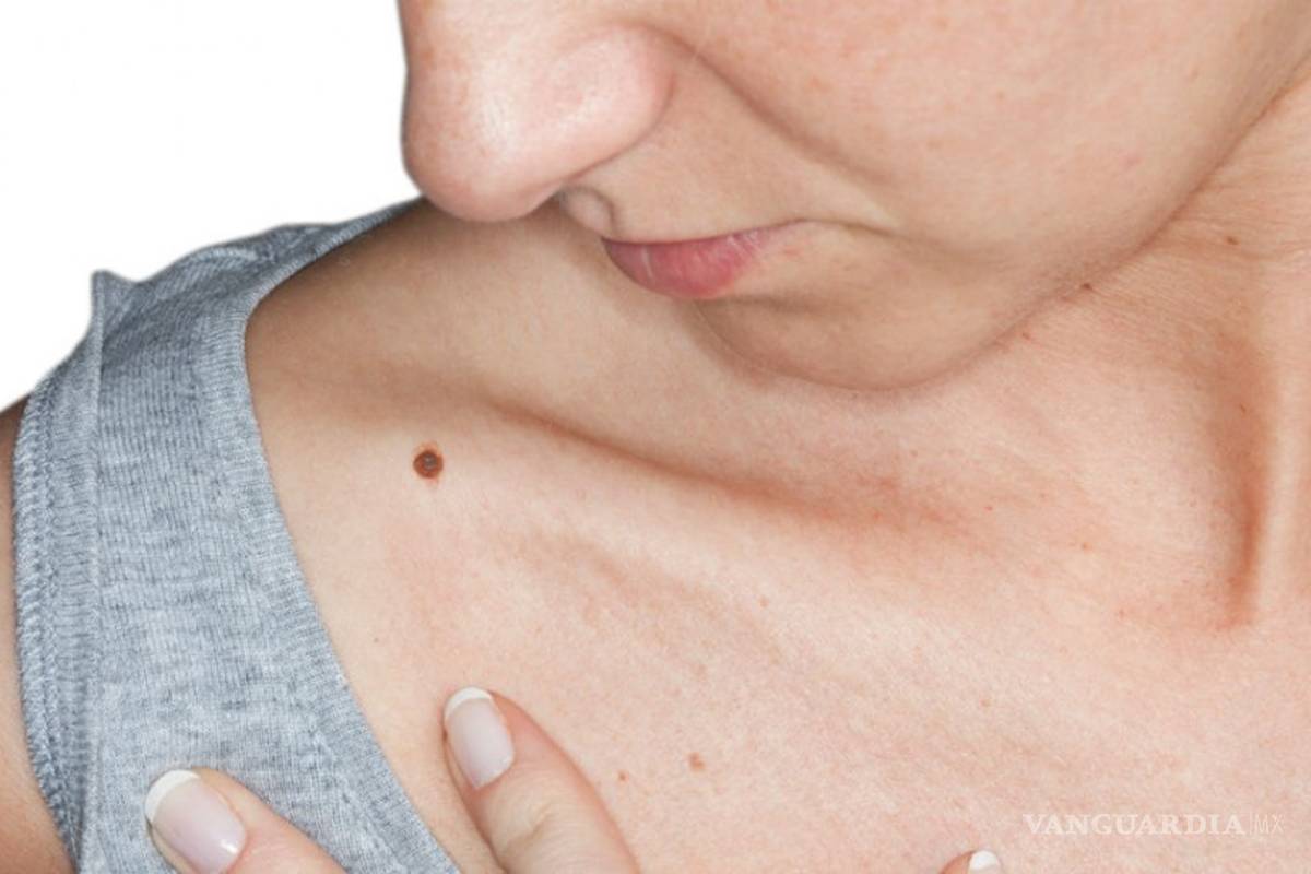 Estudiantes del IPN crean sistema de detección temprana de cáncer de piel