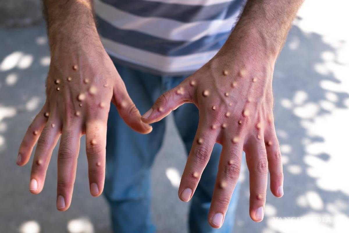 ‘La Viruela del Mono no es capaz de provocar pandemia como el COVID-19’, asegura Roberto Bernal Gómez