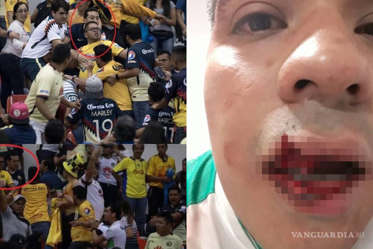 Aficionado del Santos requirió de una cirugía reconstructiva en el rostro tras la brutal golpiza que recibió de inadaptados americanistas