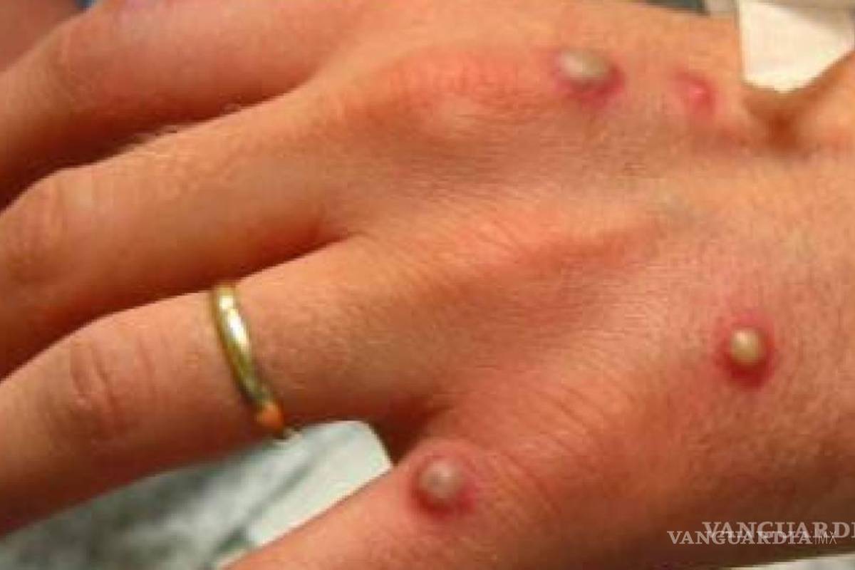 Reportan OMS aumento del 77% de casos de viruela símica en una semana