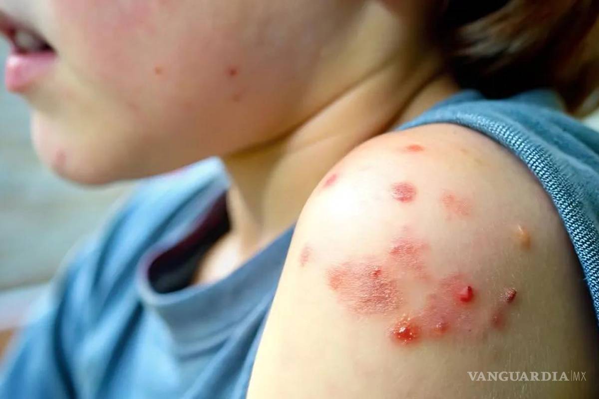Sarampión en México... Secretaría de Salud emite alerta por incremento en casos ¿qué medidas debo tomar?
