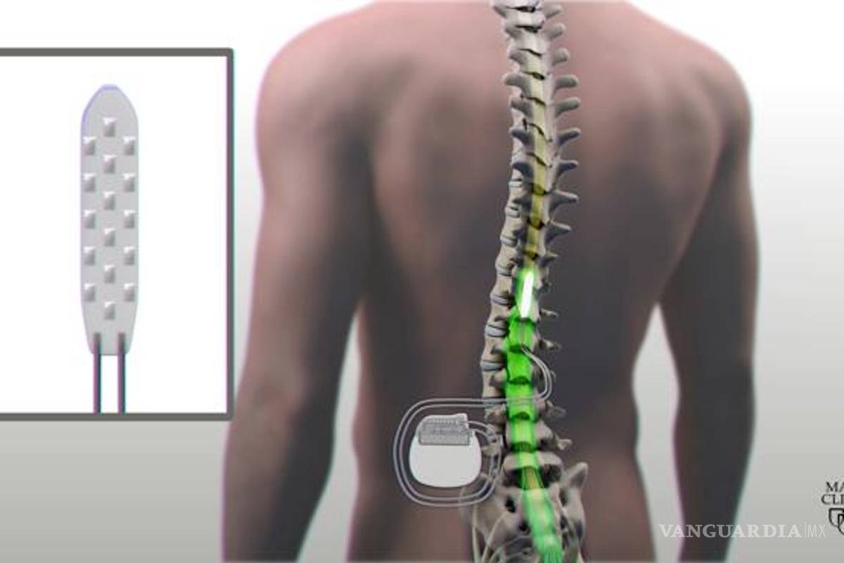 Tres personas parapléjicas recuperan la capacidad de caminar con innovadora terapia