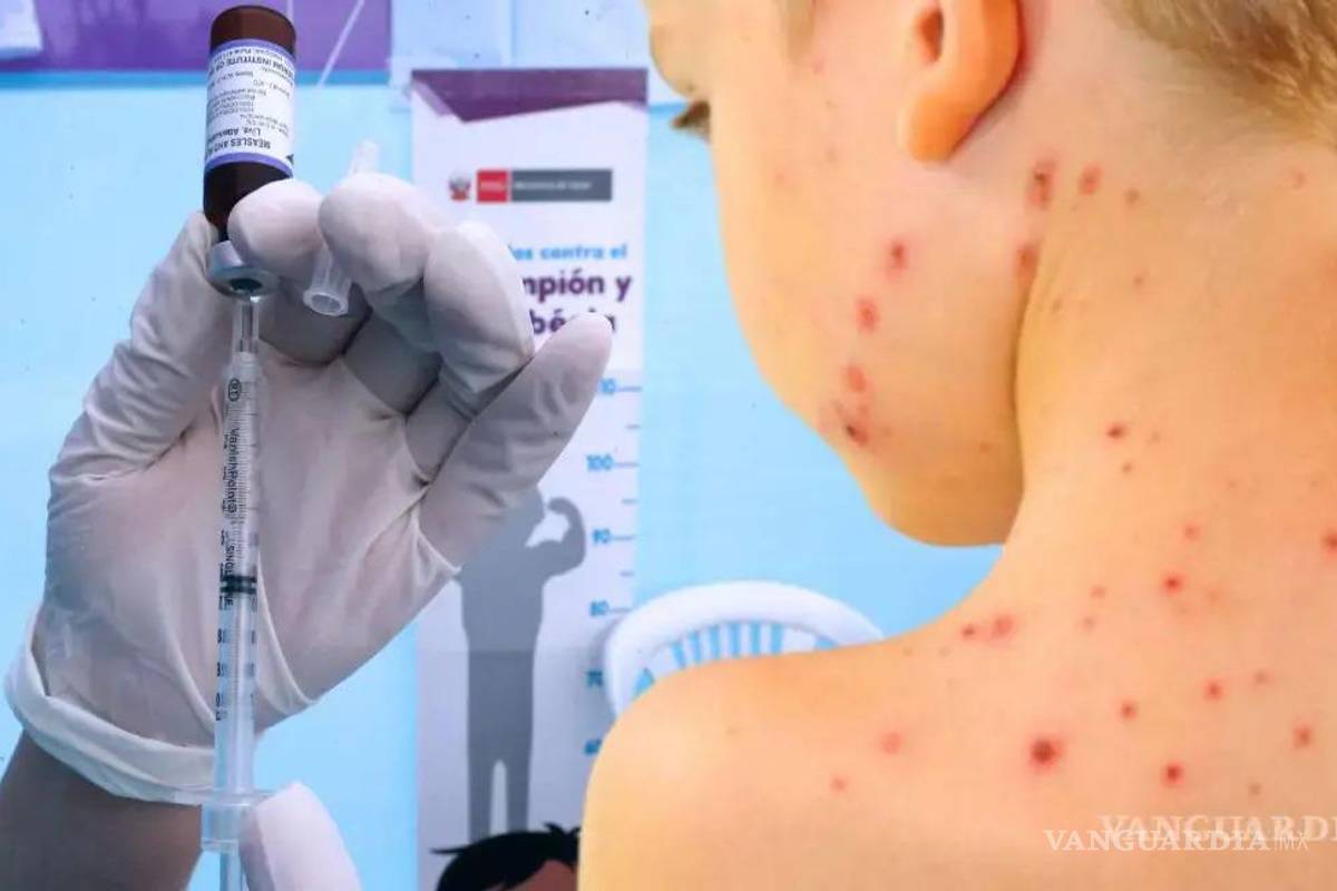 Coahuila suma ya 47 casos de sarampión; se mantiene en el tercer lugar nacional en número de contagios