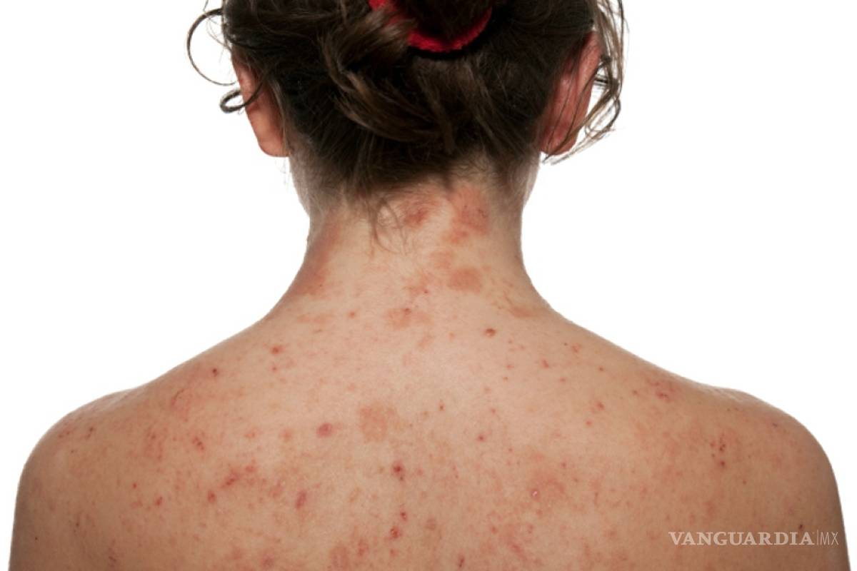 7+ consejos para controlar la dermatitis o eccema