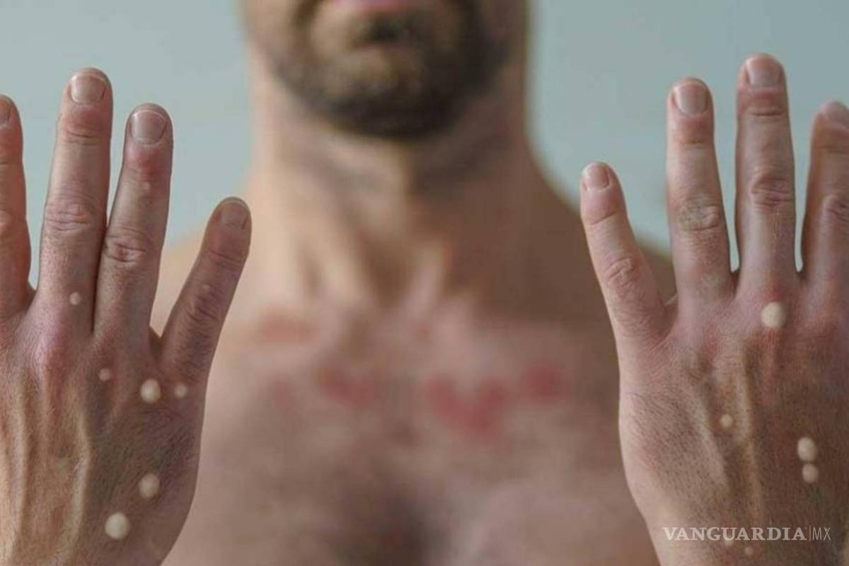 México suma mil 968 casos de viruela del mono; 341 en una semana