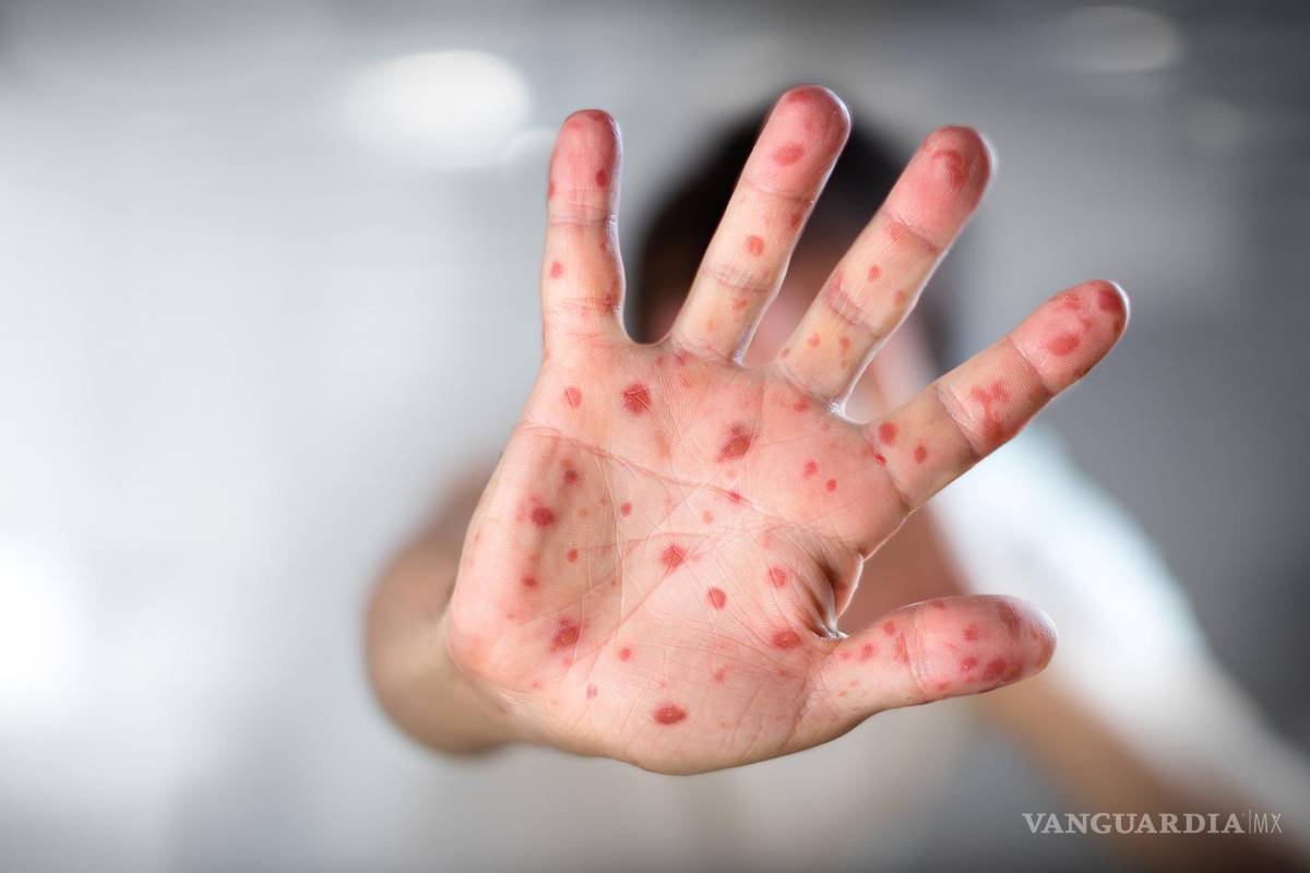 Emiten alerta para detectar casos de viruela del mono en México