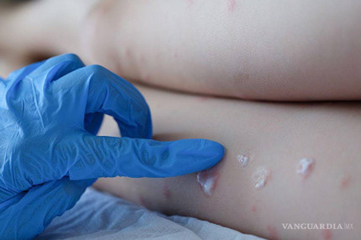 Detecta RU aumento de contagios de viruela del mono; OMS advierte que seguirán apareciendo casos
