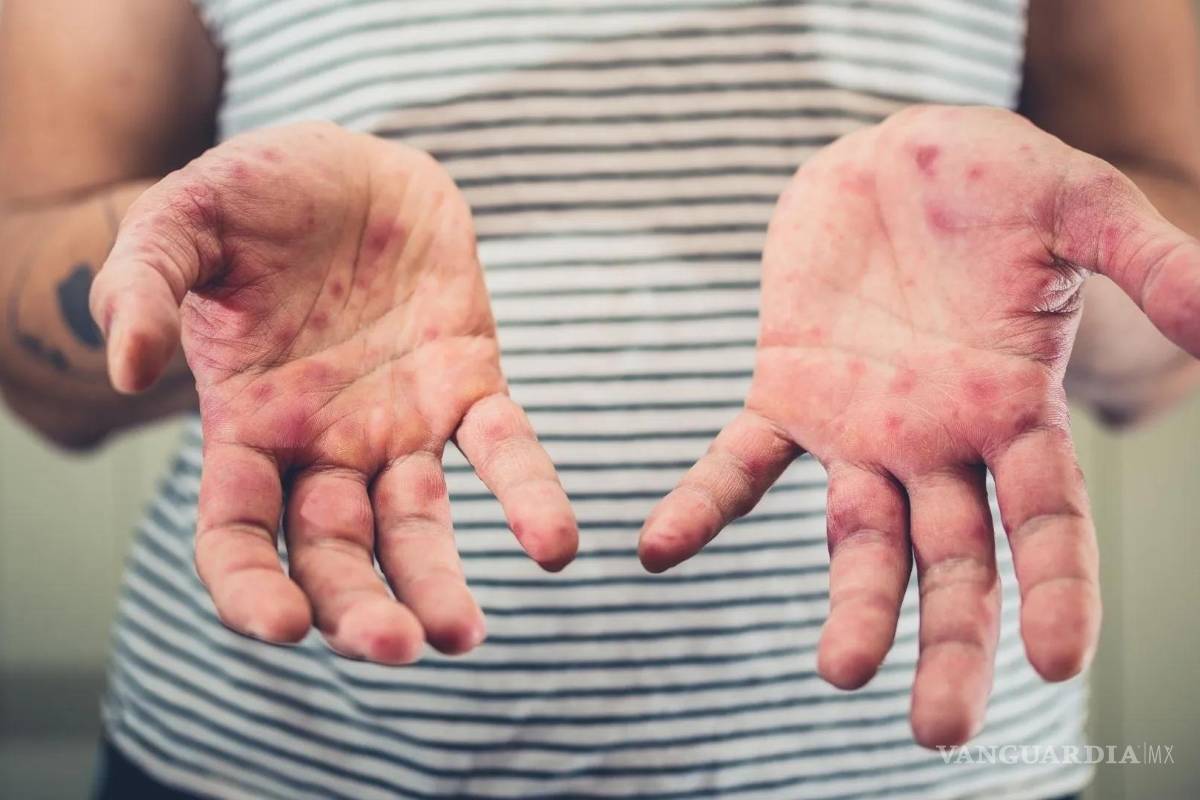 Implementan cerco sanitario en escuelas de Piedras Negras por casos de sarampión