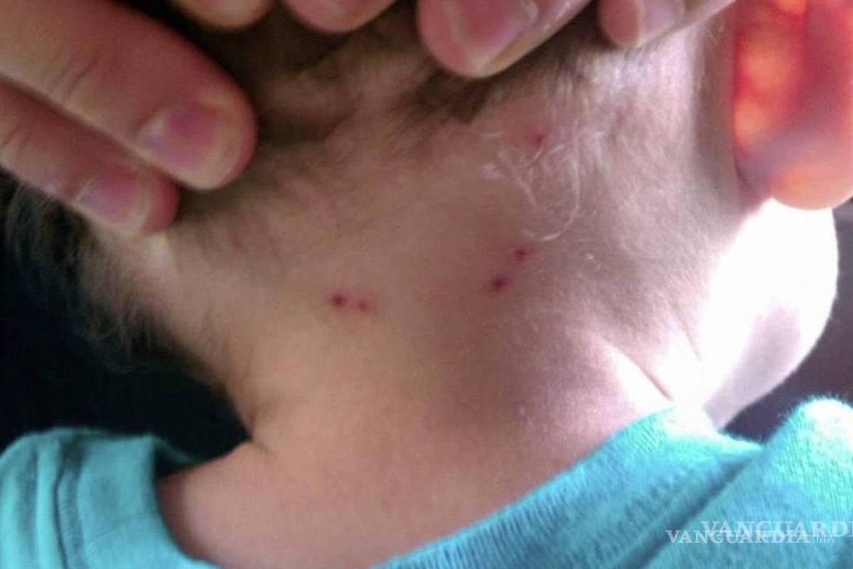 Saltillo es el municipio con mayores casos de muertes por rickettsia: Salud de Coahuila