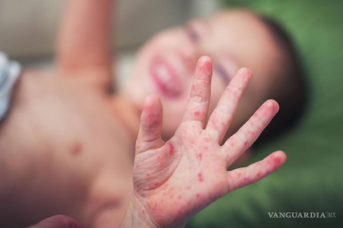 Informa SSA disminución significativa del brote de sarampión, aunque advierte cautela