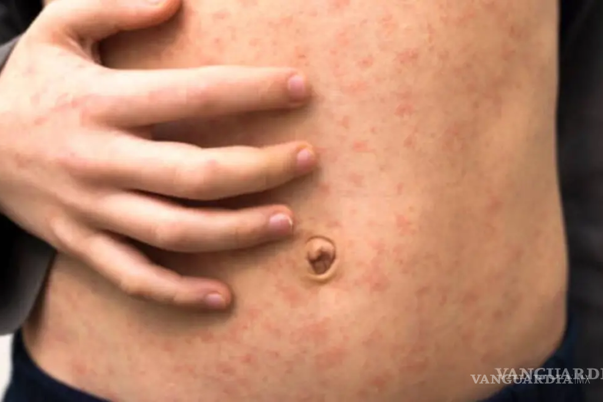 Coahuila registra 53 casos de sarampión; es el tercero a nivel nacional