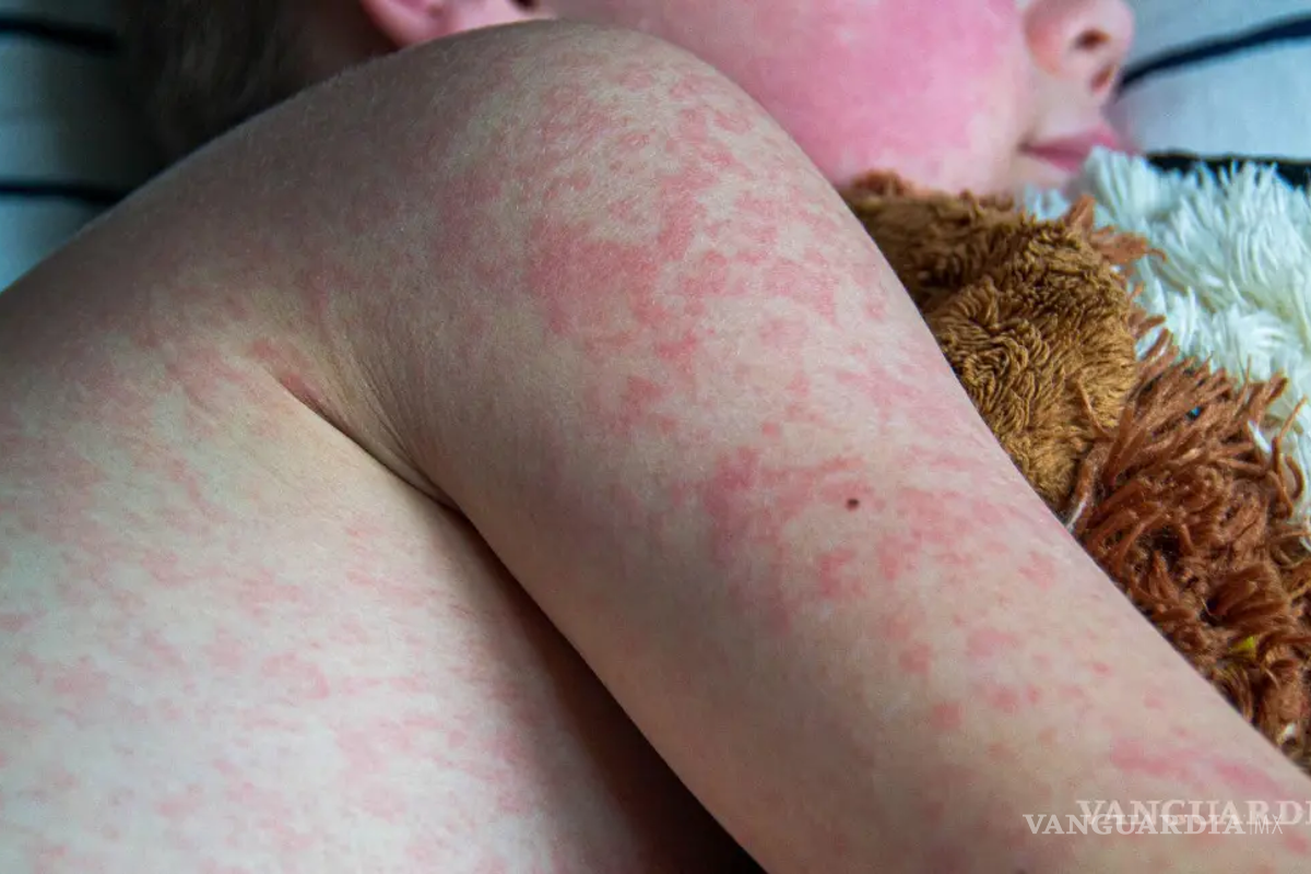 Sarampión pone en alerta a Piedras Negras con 41 casos sospechosos