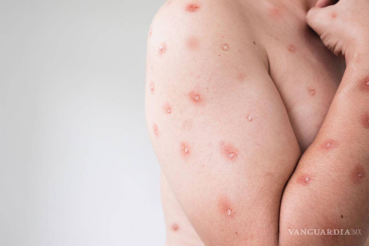 Suman 55 casos viruela del mono en México; Coahuila continúa con un caso sospechoso