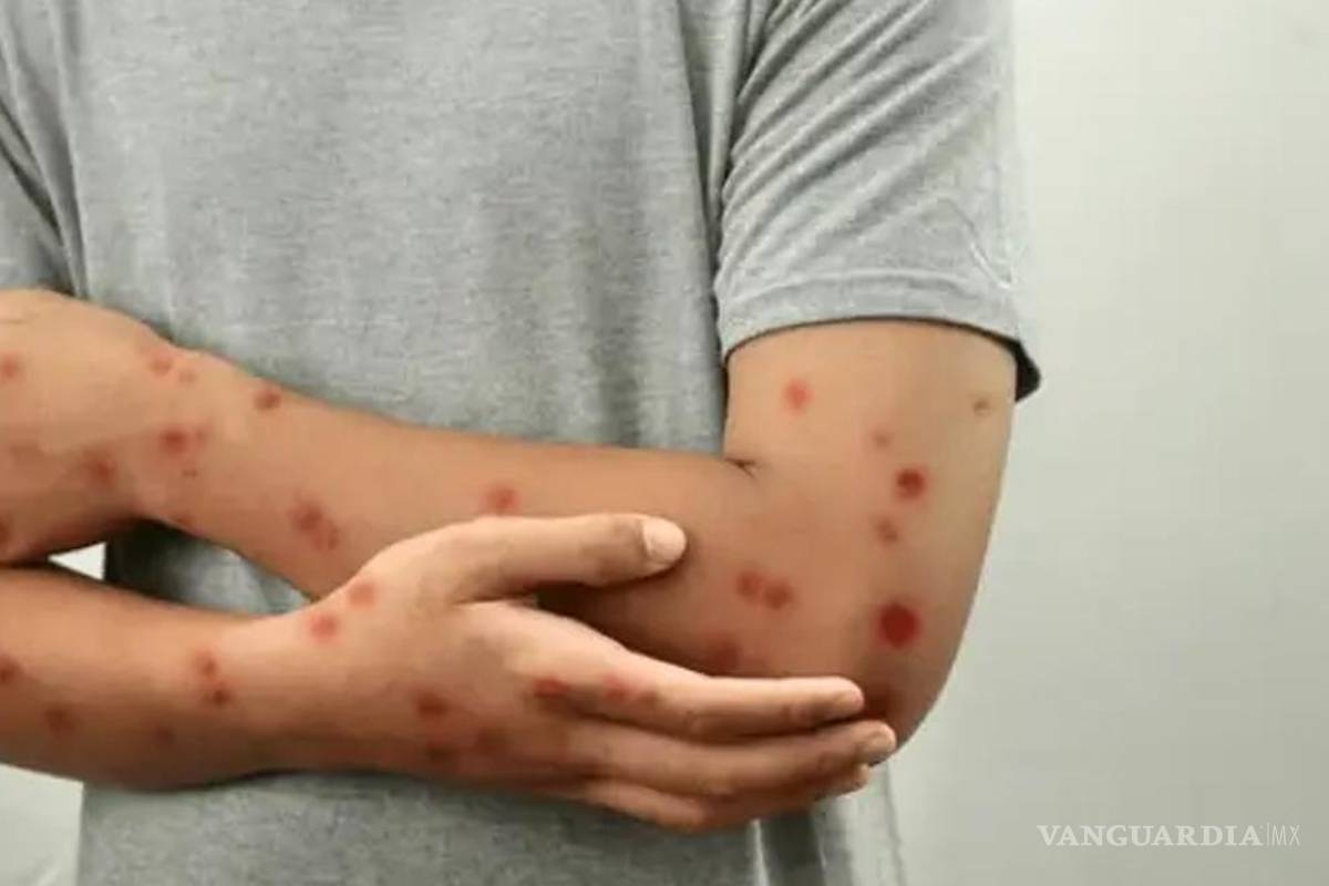 Viruela del mono crece en México... casos aumentan hasta 10 veces; aquí los estados con más contagios