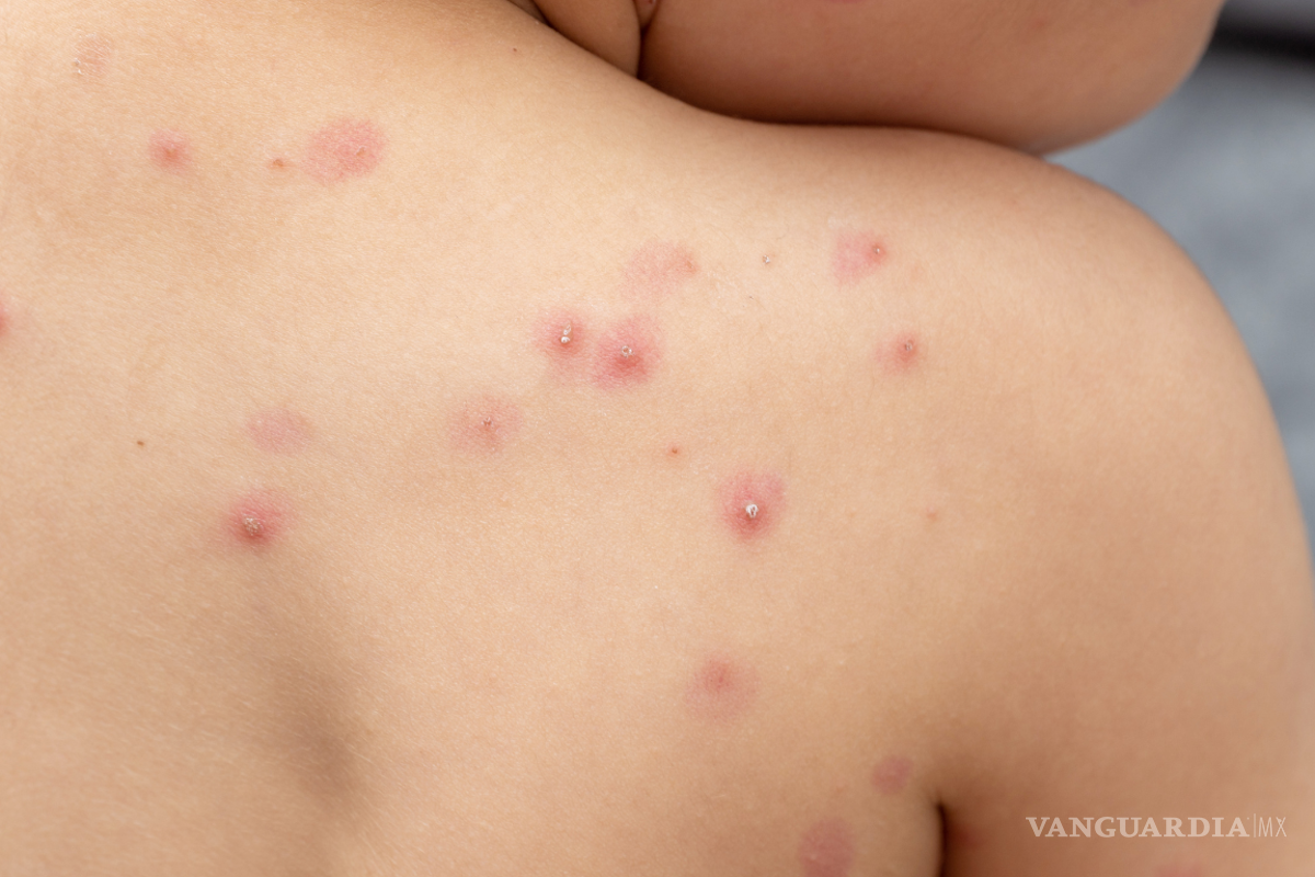 Primer caso de viruela del mono en México es confirmada por López-Gatell