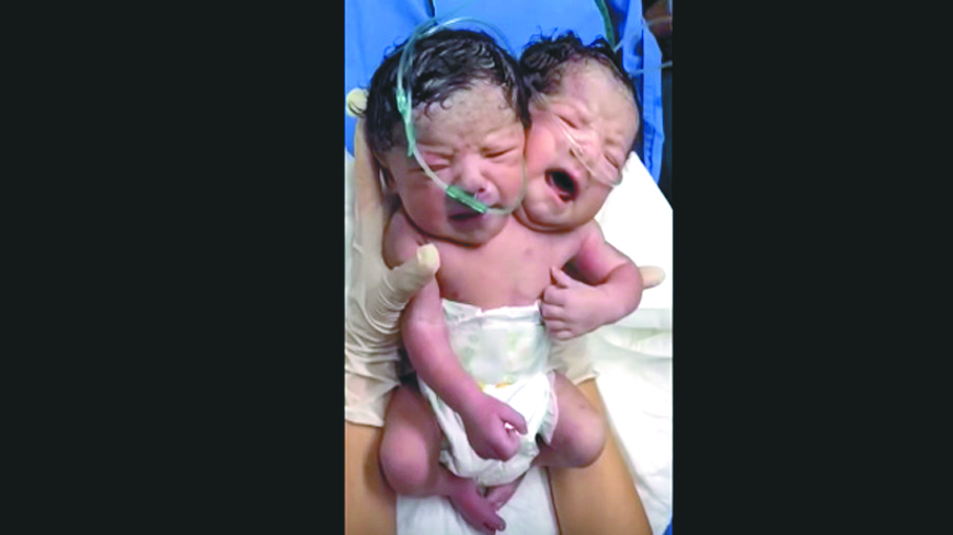 ¿Siameses o bebé de 2 cabezas?