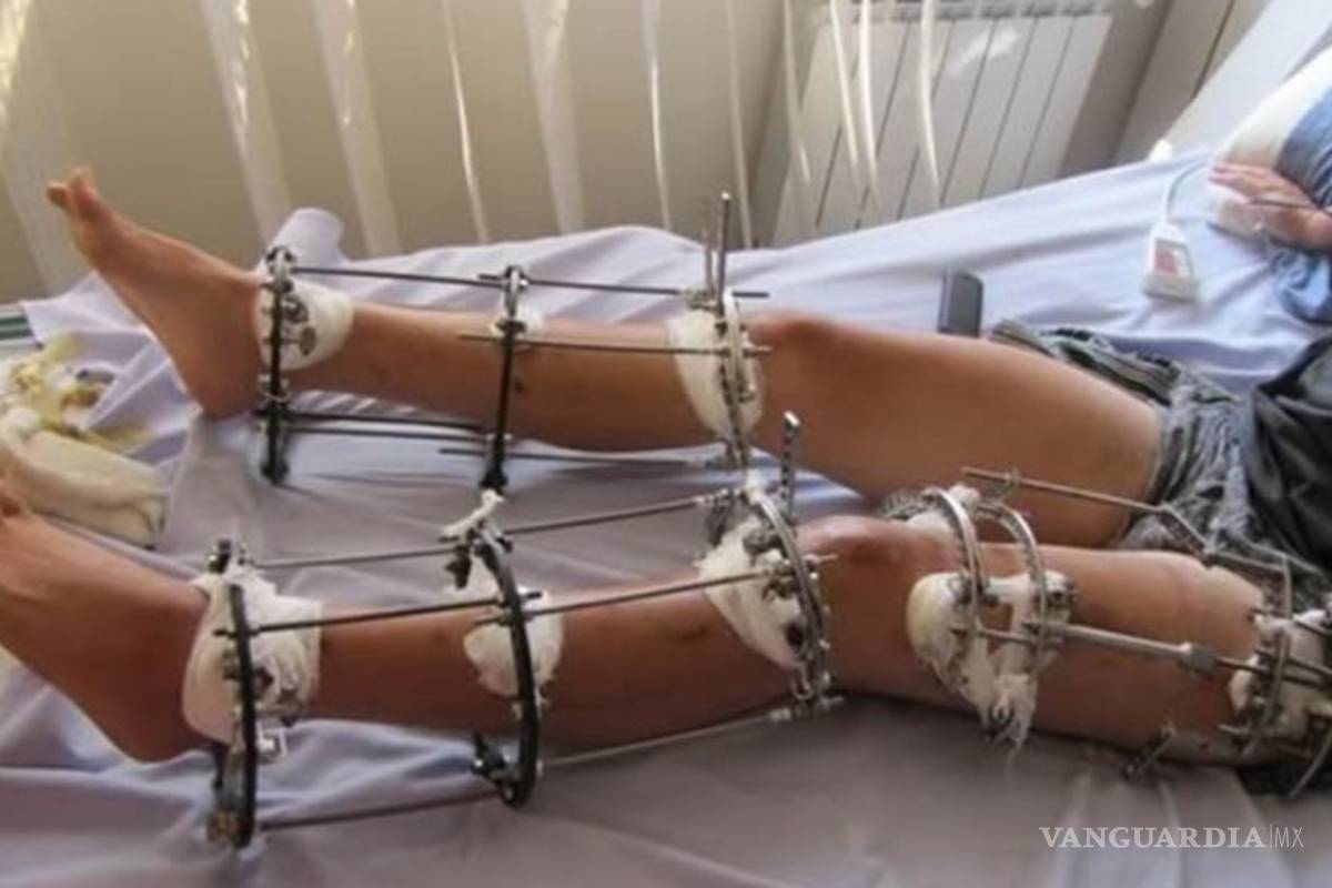 Alargar las piernas para ser más alto, la dolorosa operación que gana popularidad en todo el mundo