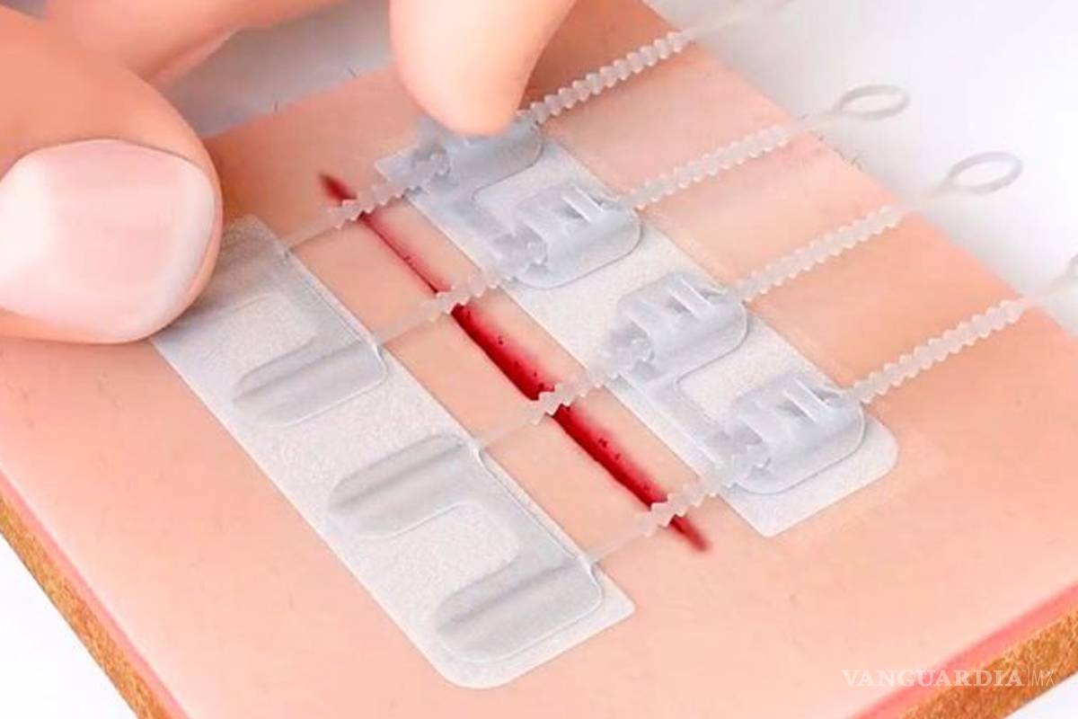 ZipStitch, con este dispositivo podrás cerrar heridas sin sutura
