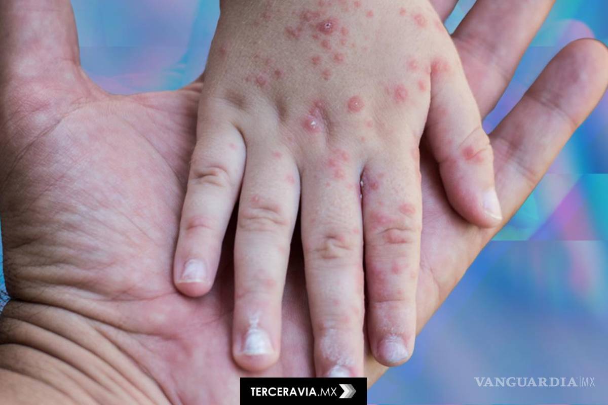 Sigue activa la alerta por contagios de sarampión; incidencia se ha frenado en Coahuila