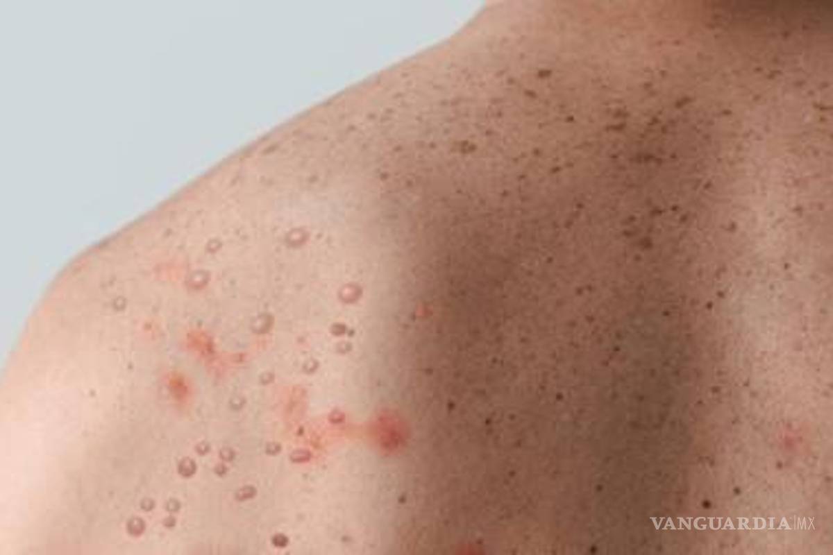 Mpox, qué es y qué recomienda la Secretaría de Salud