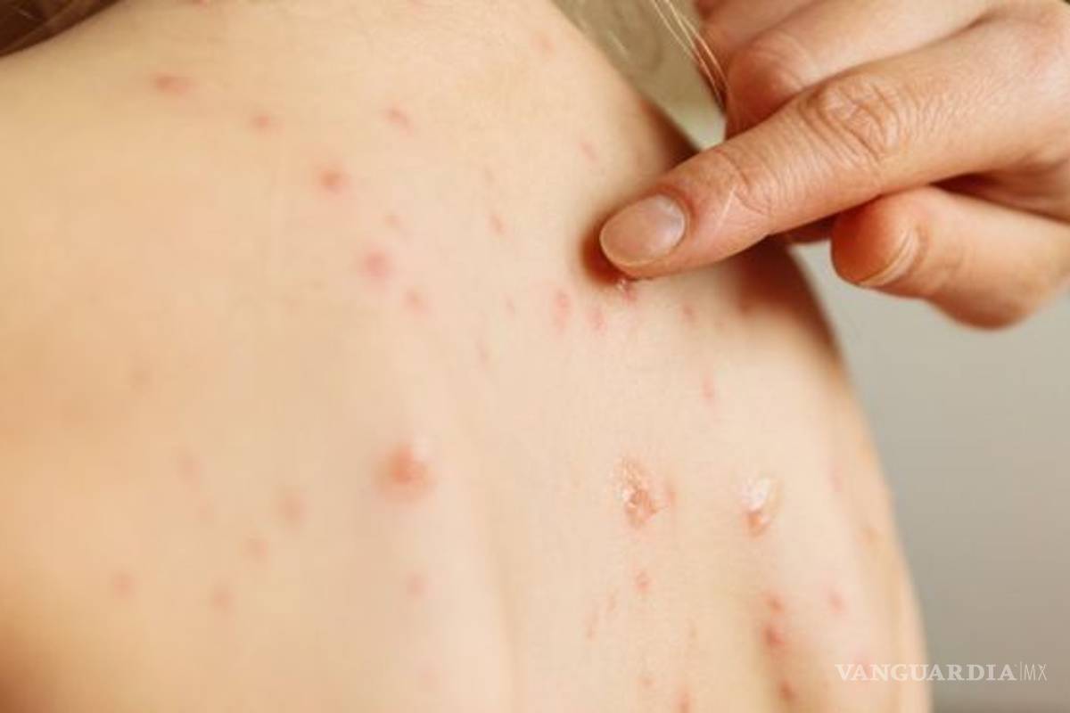 Epidemia de sarampión sigue imparable... suma Estados Unidos 704 casos