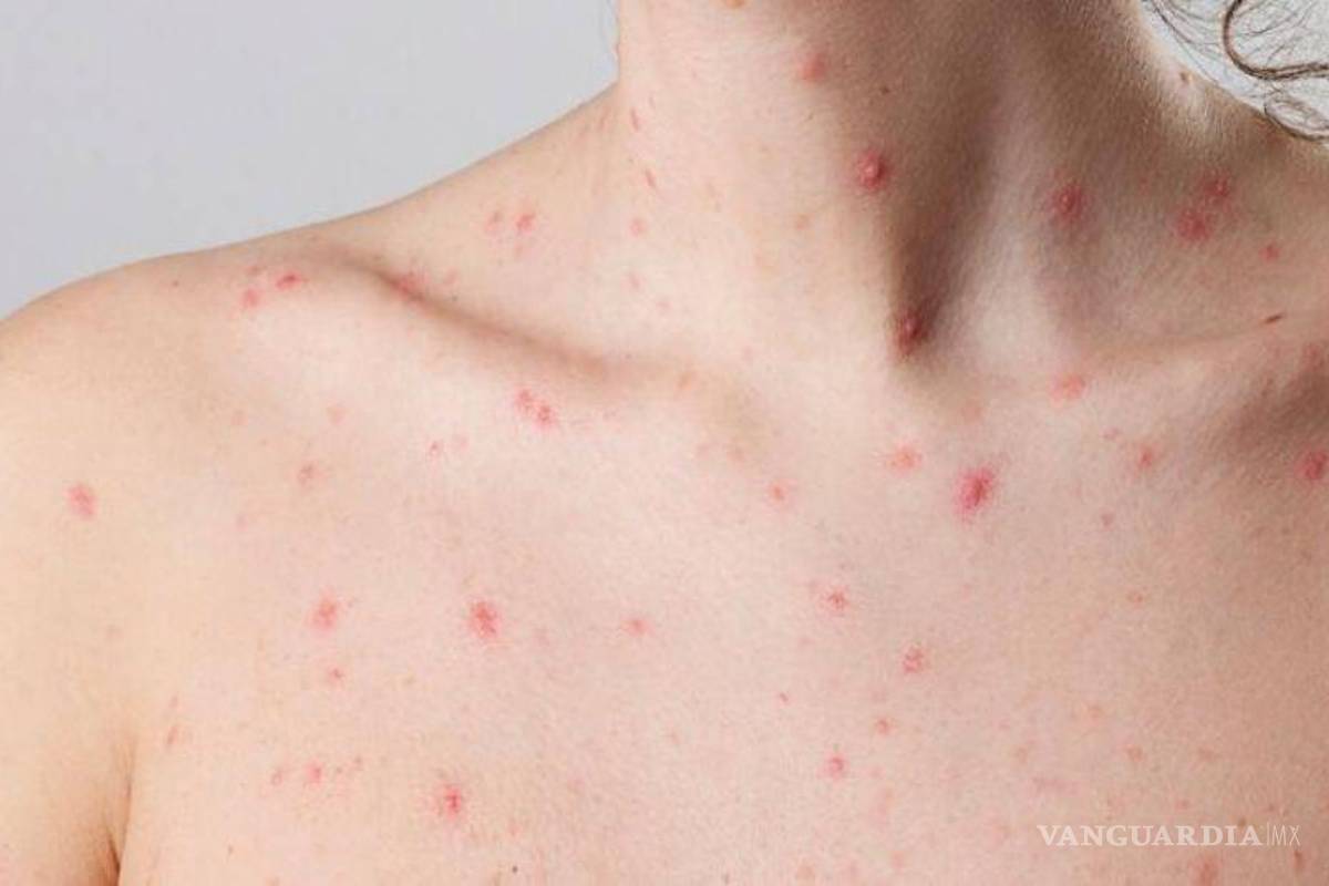 Suma Yucatán hasta seis casos de viruela símica en sólo una semana