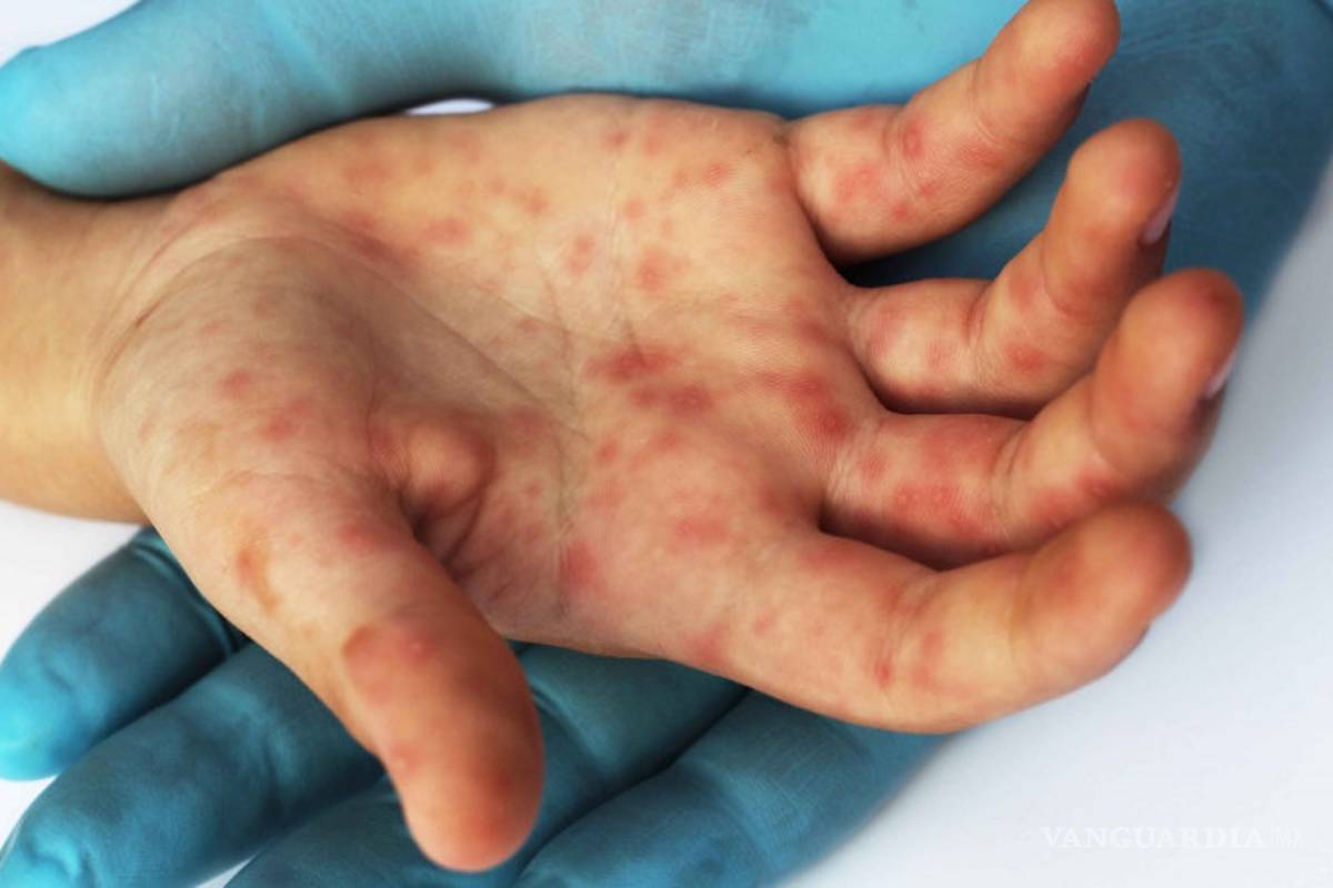 Descartan casos de sarampión en Coahuila