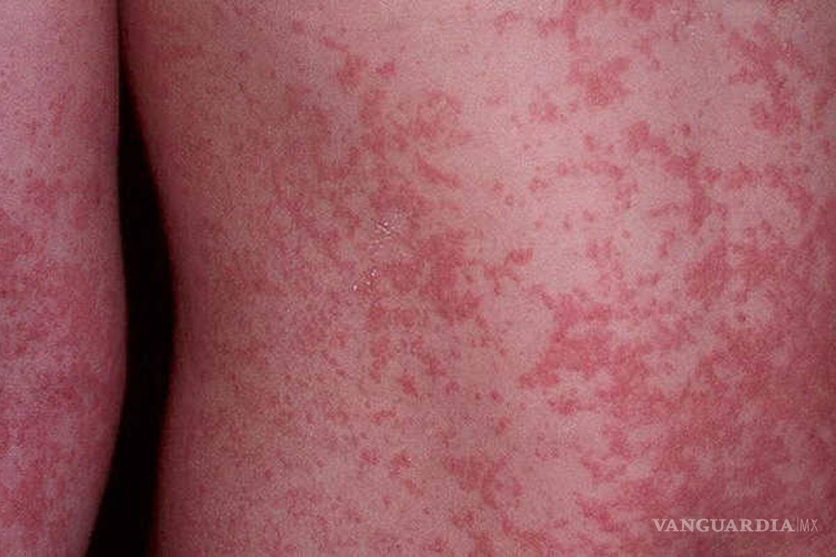 Virus del zika: Cómo se contagia, se manifiesta y se evita