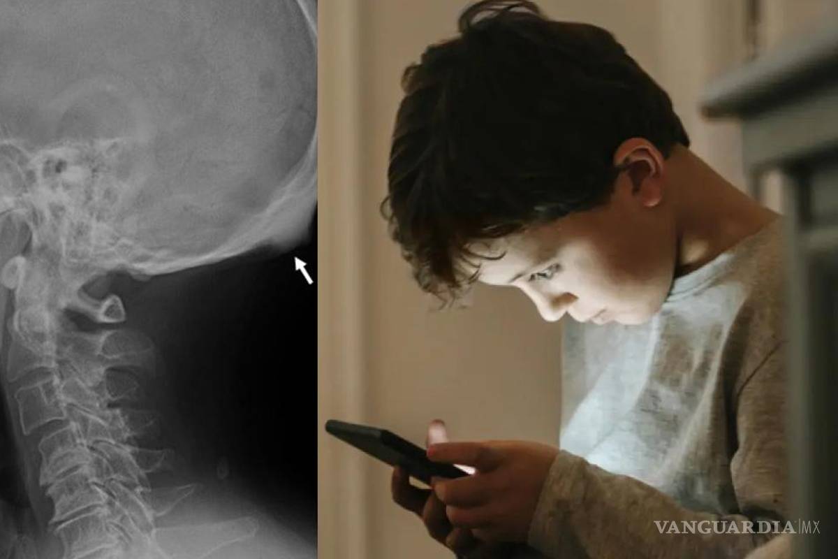 ¿Qué es el ’cuerno del celular’?... el espolón óseo que aparece por su uso prolongado y podría ser peligroso