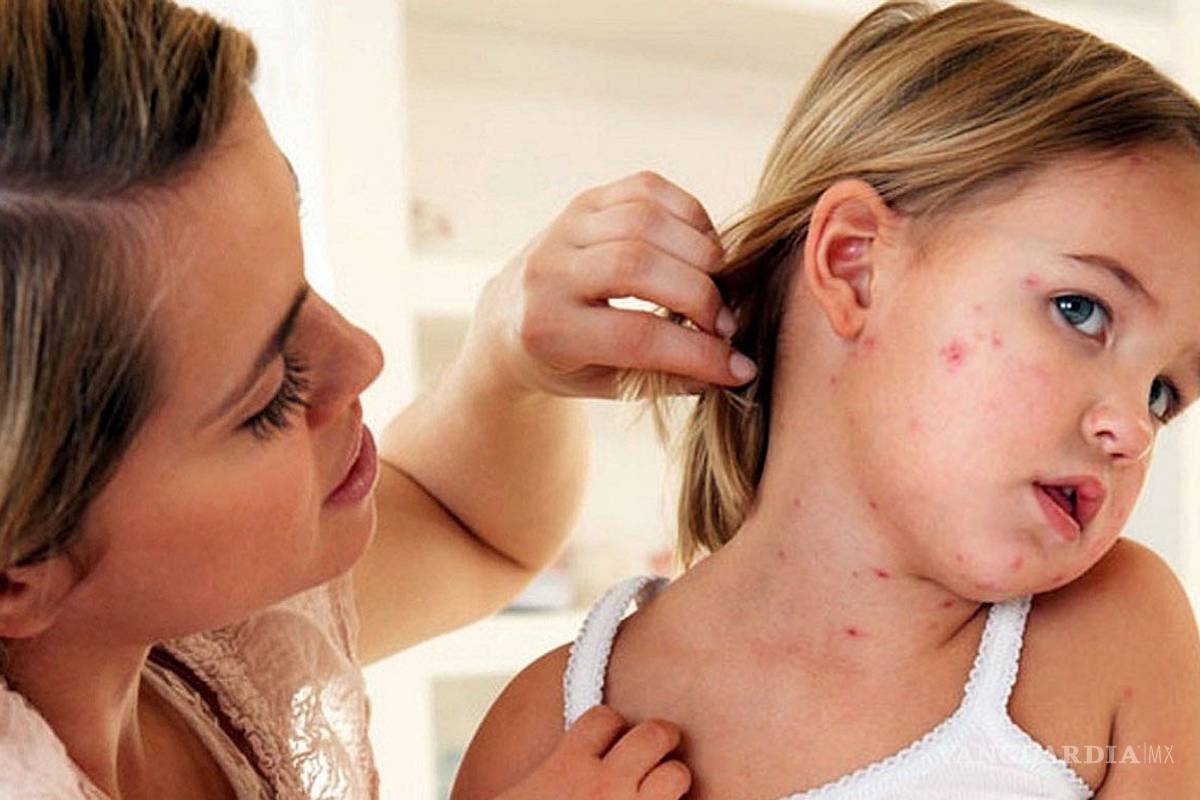 La varicela no entra en el paquete básico de vacunas