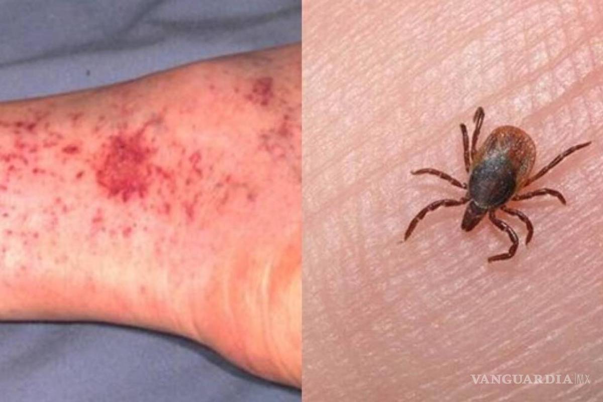 Salud Coahuila anuncia capacitación para detectar y tratar la rickettsiosis