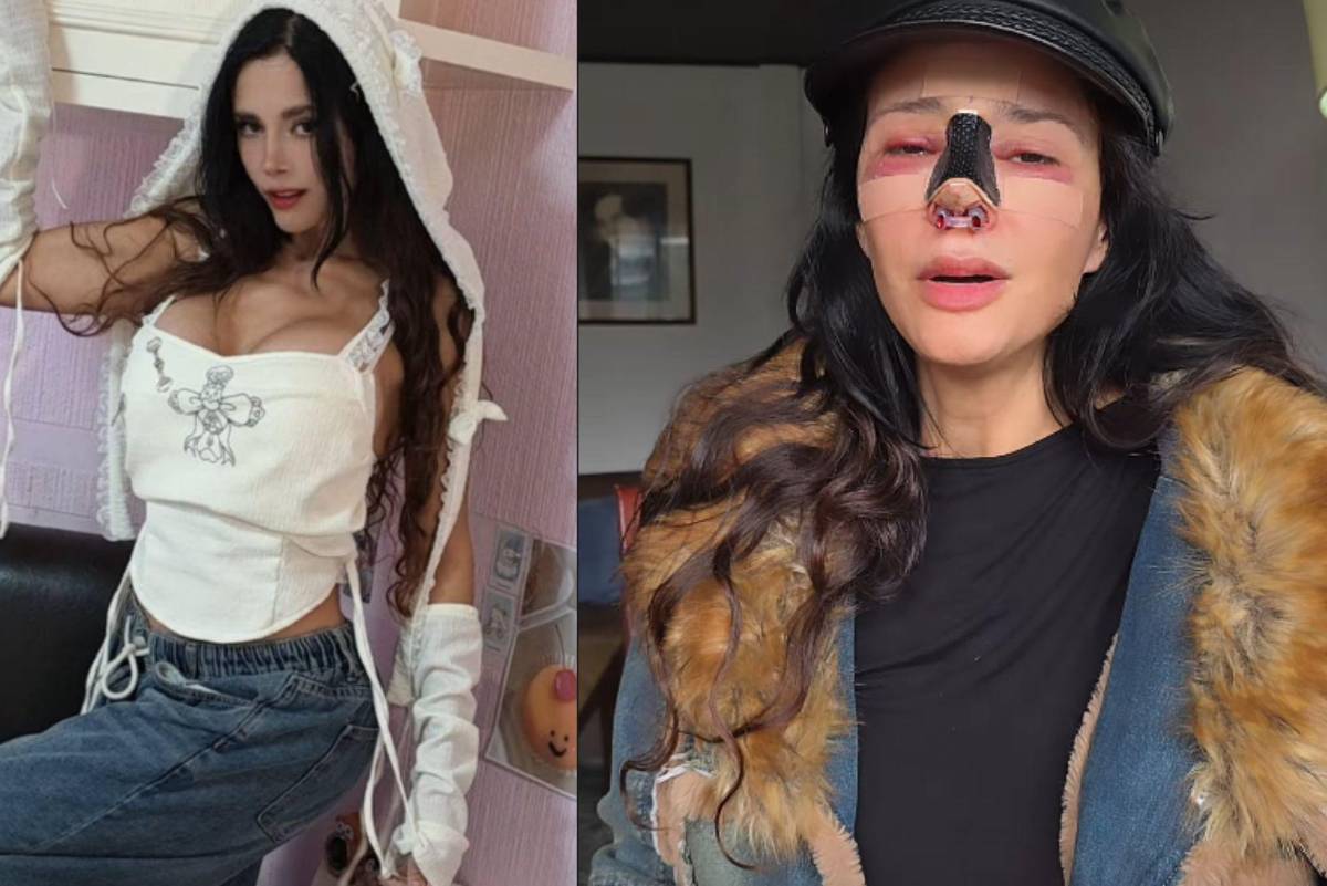 Dorismar, modelo y presentadora de Televisa, muestra resultados de cirugía estética fallida