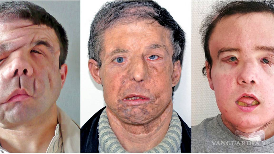 $!Por primera vez en la historia un hombre pasa por dos trasplantes de cara