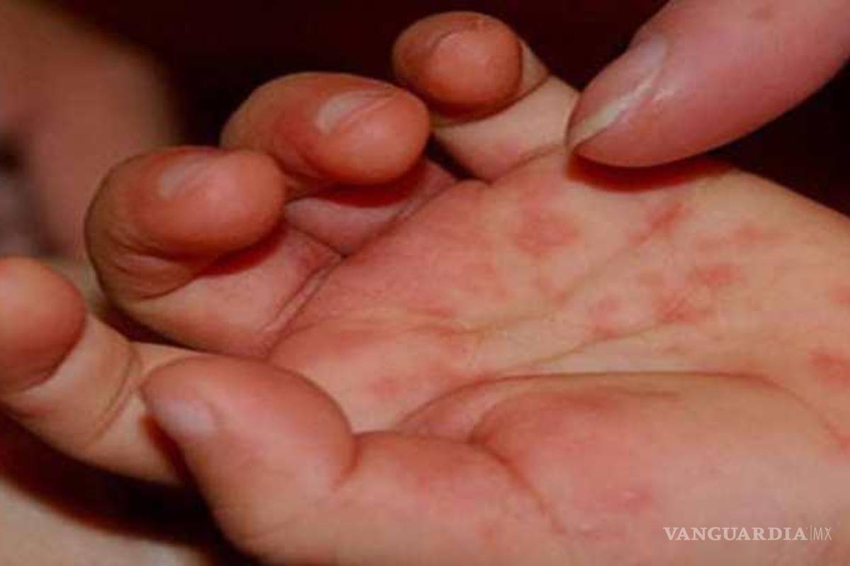 Coahuila en top tres con casos graves de rickettsia: Cenaprece