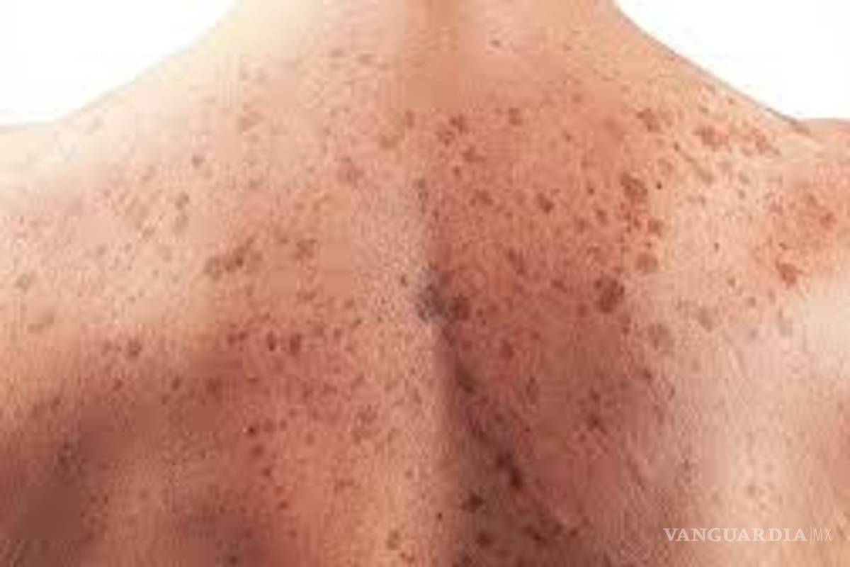 Ordenador logra detectar cáncer de piel