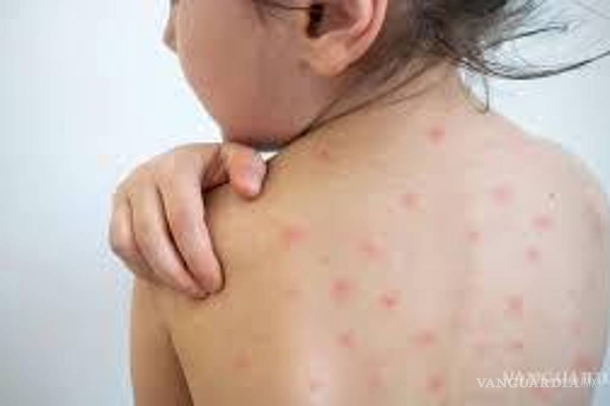 Alerta Secretaría de Salud Coahuila por aumento de casos de Sarampión en Estados Unidos y Sudamérica