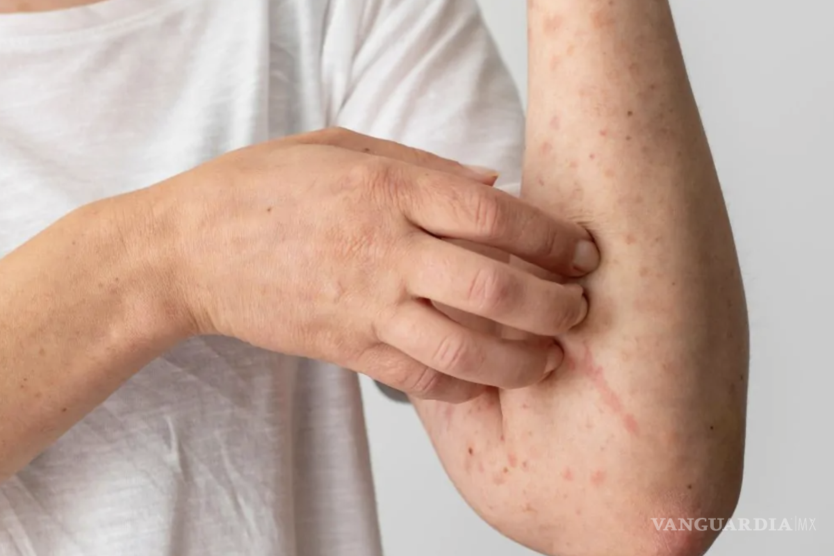 $!El Sistema Especial para la Vigilancia Epidemiológica ha confirmado 9 mil 074 casos.