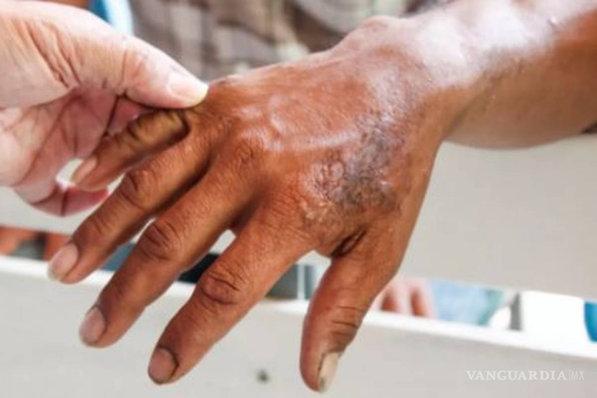 Detectan dos casos de lepra en Coahuila
