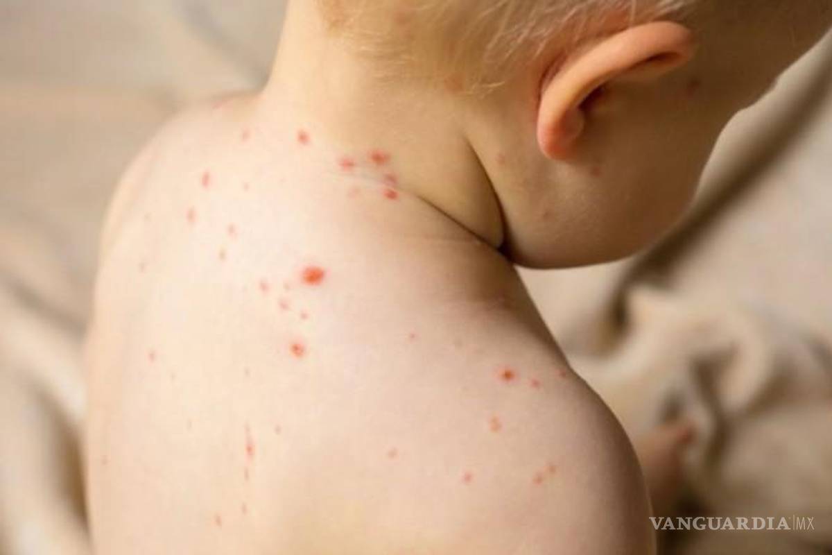 Coahuila refuerza prevención ante alerta por gripe aviar y sarampión