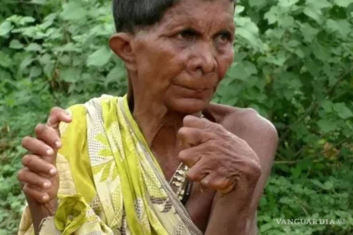 Mujer de la India nace con 20 dedos en los pies y 12 en las manos, la comparan con una bruja