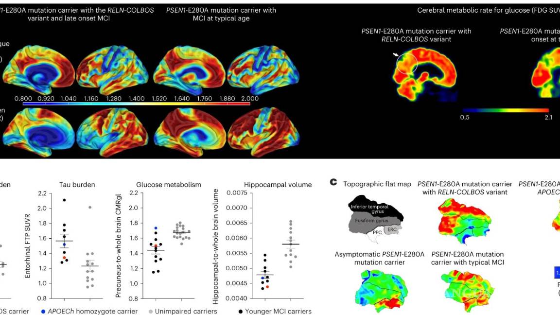 $!Grafica 1: Imagen del PET del portador del gen RELN-COLBOS (H3447R).