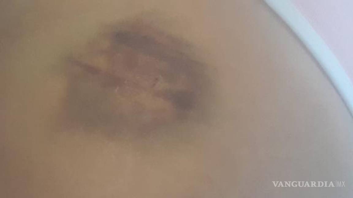 $!La afectada presentó heridas visibles tras la agresión por parte de un empleado de la taquería.