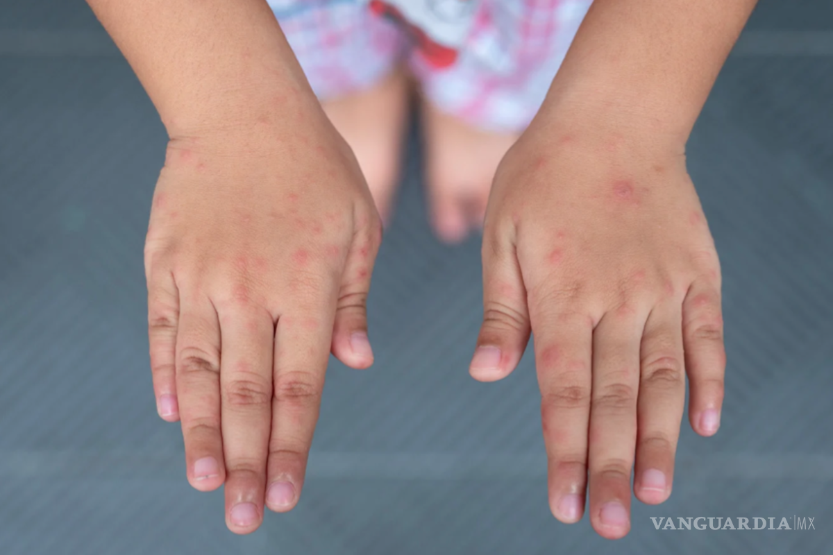 Detectan tres brotes de virus mano-pie-boca en escuelas de Piedras Negras